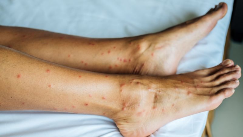 Jambes allongées présentant de nombreuses piqûres rouges groupées – aspect pouvant évoquer des puces ou des punaises.